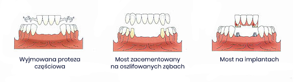 Implantologia stomatologiczna Szczecin