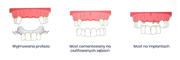 Implantologia stomatologiczna Szczecin